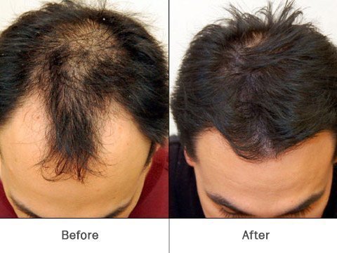 HairFortin before and after results